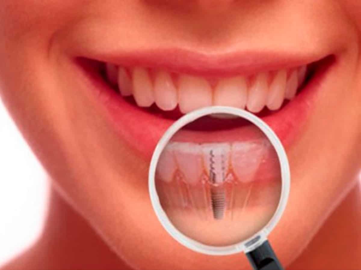Cu Les Son Las Fases De Colocaci N De Un Implante Cl Nica Dental Satorres