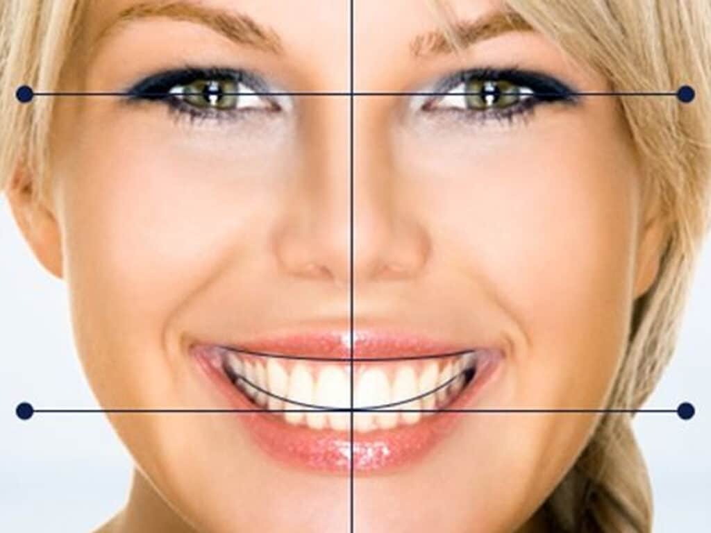 ¿Qué es el Diseño Digital de Sonrisa?