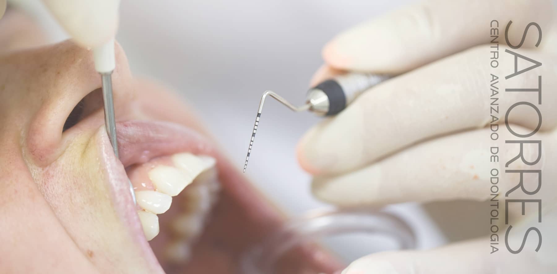 ¿Cómo prevenir la periodontitis?