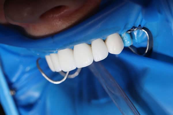 Carillas dentales y Mock-up | Clínica Dental Satorres en Paterna y Manises