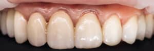 Corona de Zirconio Montada | Clínica Dental en Paterna y Manises