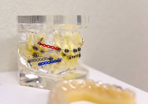 Mock up para ortodoncia | Clínica Dental Satorres en Paterna y Manises