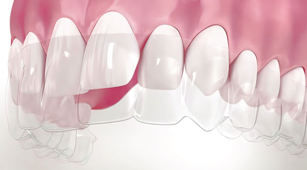 Esquema Invisalign Ortodoncia Invisible | Clínica Dental Satorres | Paterna Manises