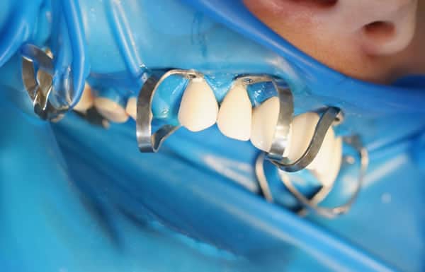 Colocación de Carillas de Clínica Dental Satorres en Valencia