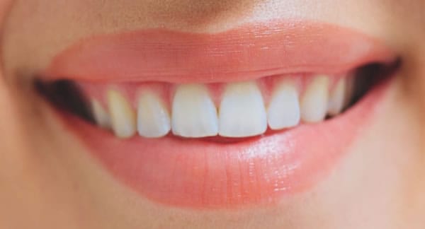 Sonrisa perfecta con Cariññas de Clínica Dental Satorres en Valencia