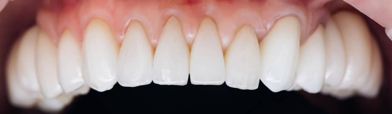 Dientes que necesitan Cariññas de Clínica Dental Satorres en Valencia
