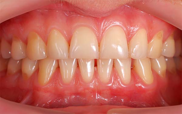 Encías Inflamadas | Clínica Dental Satorres | Paterna Manises