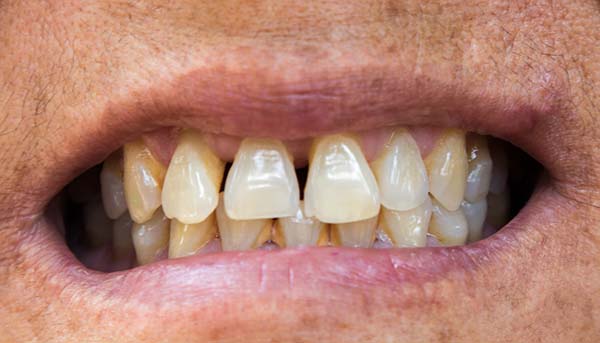 Encías Inflamadas | Clínica Dental Satorres | Paterna Manises