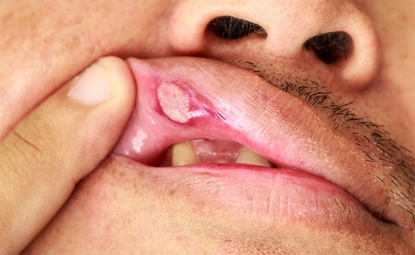 Llaga Candidiasis Oral | Clínica Dental Satorres