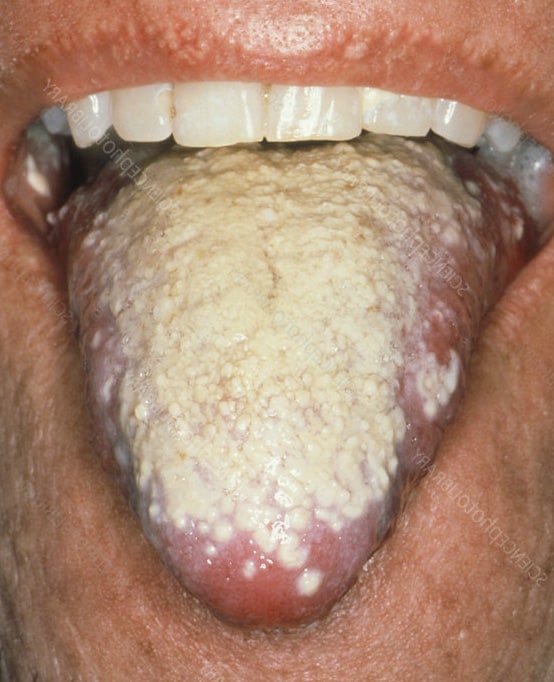 Candidiasis Oral Extrema | Clínica Dental Satorres
