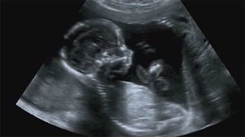 Malformación fetal Prognatismo Mandibular | Clínica Satorres Manises Paterna