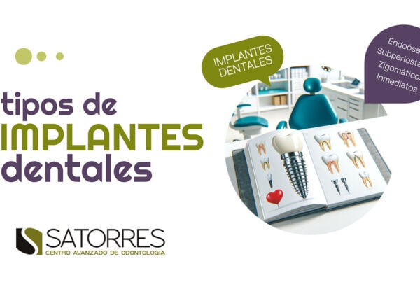 Banner Tipos de Implante | Clínica Dental Satorres