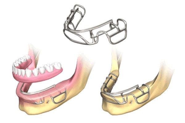 Implante Subperiostales | Clínica Dental Satorres
