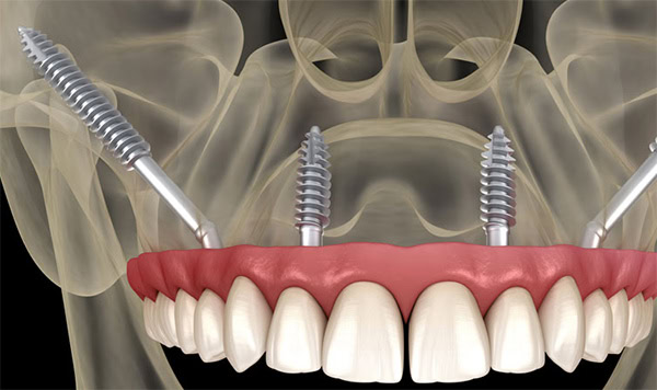 Implantes Zigomáticos | Clínica Dental Satorres