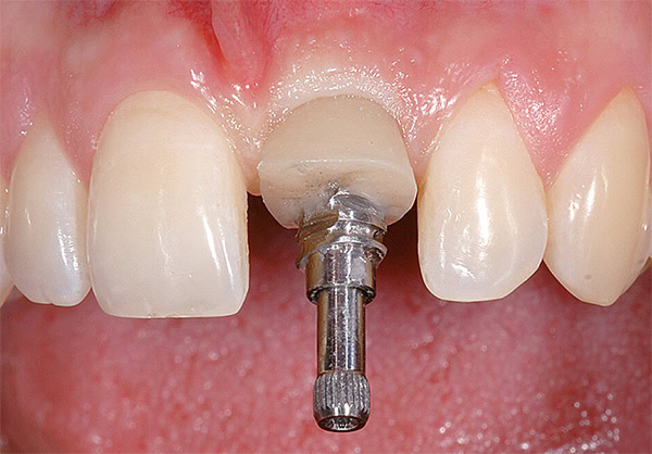 Implantología Inmediata | Clínica Dental Satorres