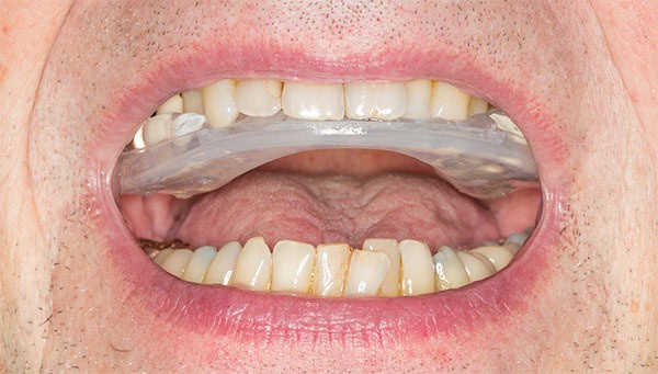 Molde Dentadura Postiza | Clínica Dental Satorres Paterna Manises
