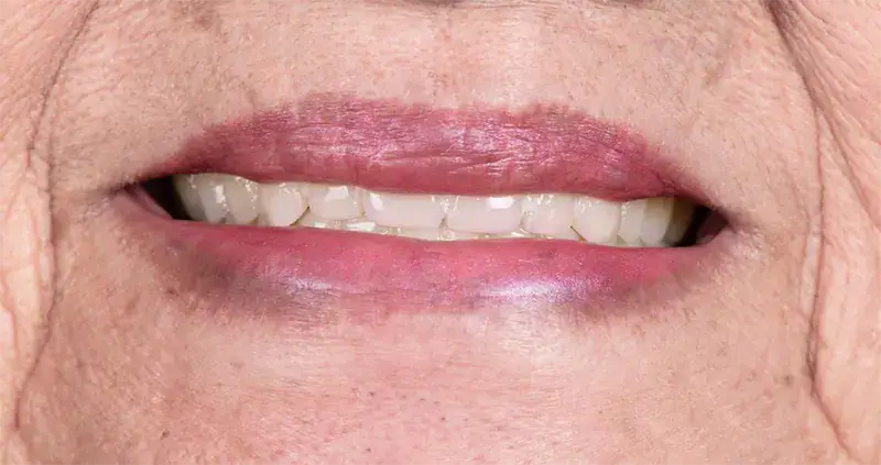Perdida de dientes en mayores | Clínica Dental Satorres