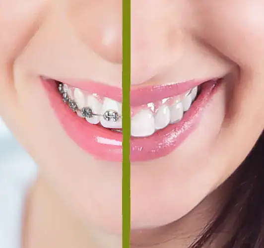 Brackets vs Ortodoncia Invisible Geniova | Clínica Dental Satorres