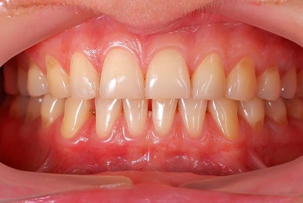 Gingivitis y Sabor metálico en la Boca | Clínica Dental Satorres Valencia