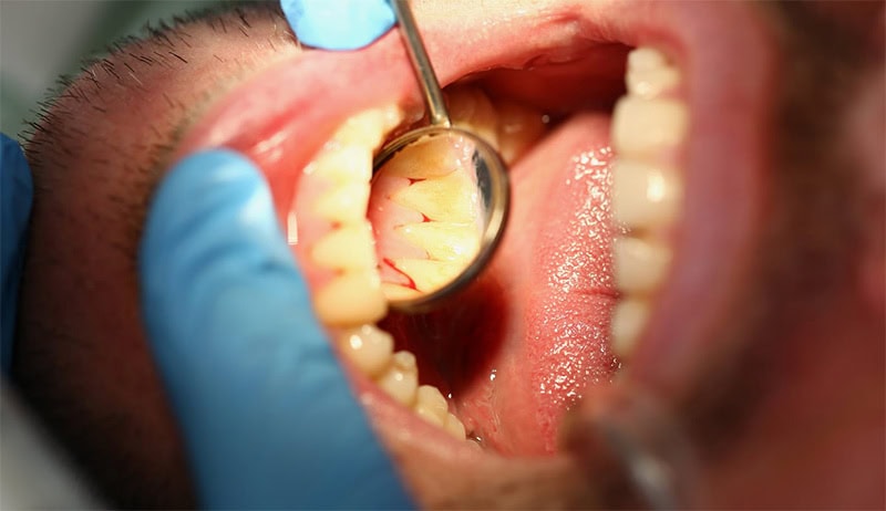 Encías inflamadas en Periodontitis | Clínica Dental Satorres Valencia