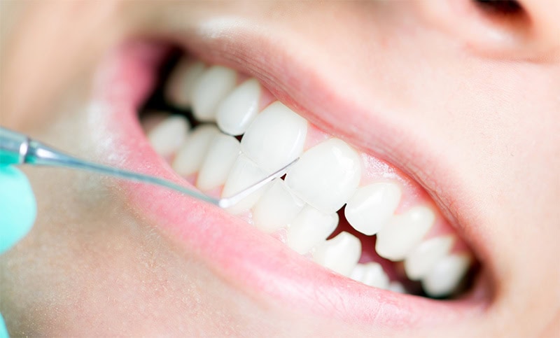 Limpieza dental para prevenir Periodontitis | Clínica Dental Satorres Valencia