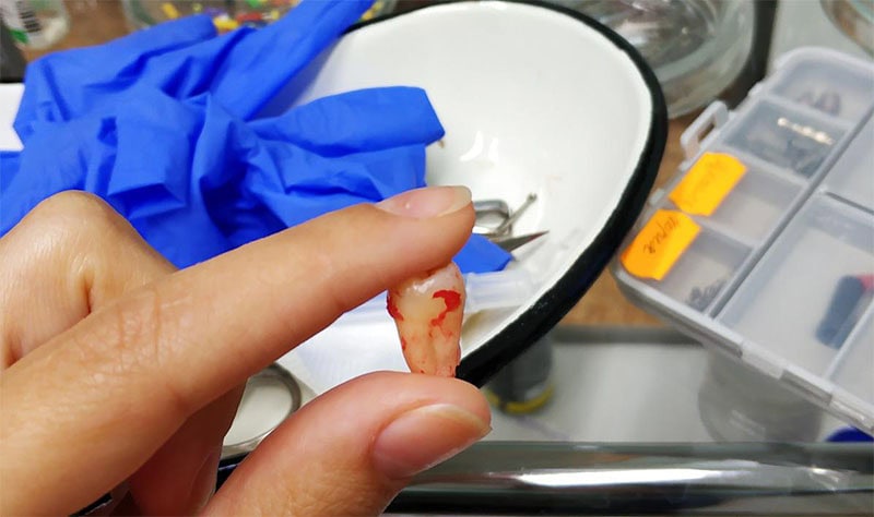 Perdida dental en Periodontitis | Clínica Dental Satorres Valencia