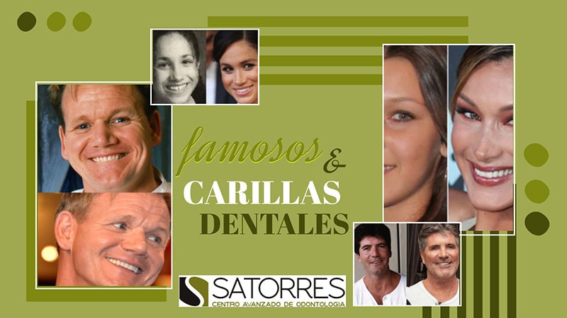 Famosos y Carillas dentales | Curiosidades *  Antes y después *