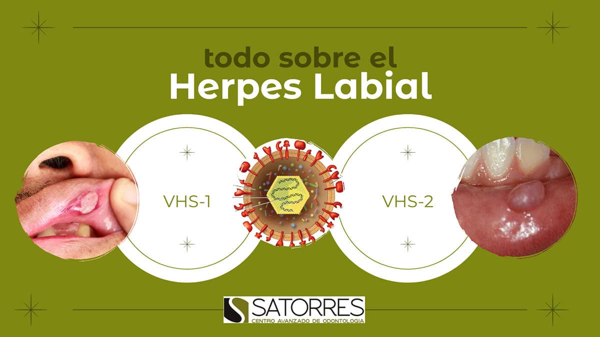 Herpes Labial. Causas. Fases. Tratamiento