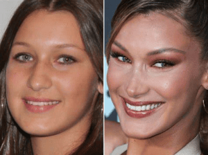 Bella Hadid - Famosos y Carillas Dentales | Clínica Dental Satorres