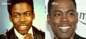 Chris Rock - Famosos y Carillas Dentales | Clínica Dental Satorres