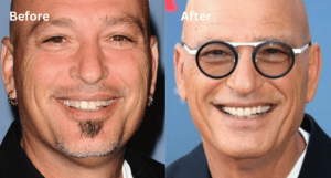 Howie Mendel - Famosos y Carillas Dentales | Clínica Dental Satorres