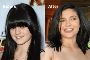 Kylie Jenner - Famosos y Carillas Dentales | Clínica Dental Satorres