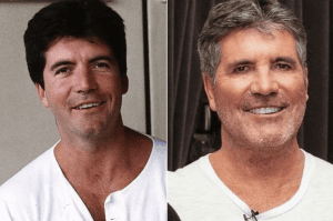 Simon Cowell - Famosos y Carillas Dentales | Clínica Dental Satorres