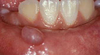 Vesícula Oral - Herpes Labial | Clínica Dental Satorres Valencia