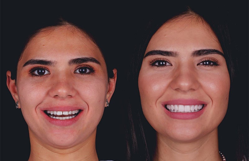 Carillas First Fit - Antes Después | Clínica Dental Satorres - Paterna - Manises