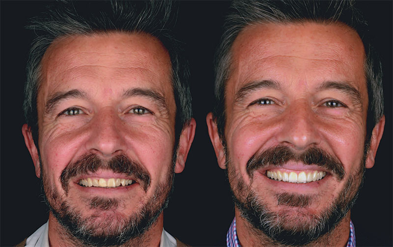 Carillas First Fit - Antes Después | Clínica Dental Satorres - Paterna - Manises