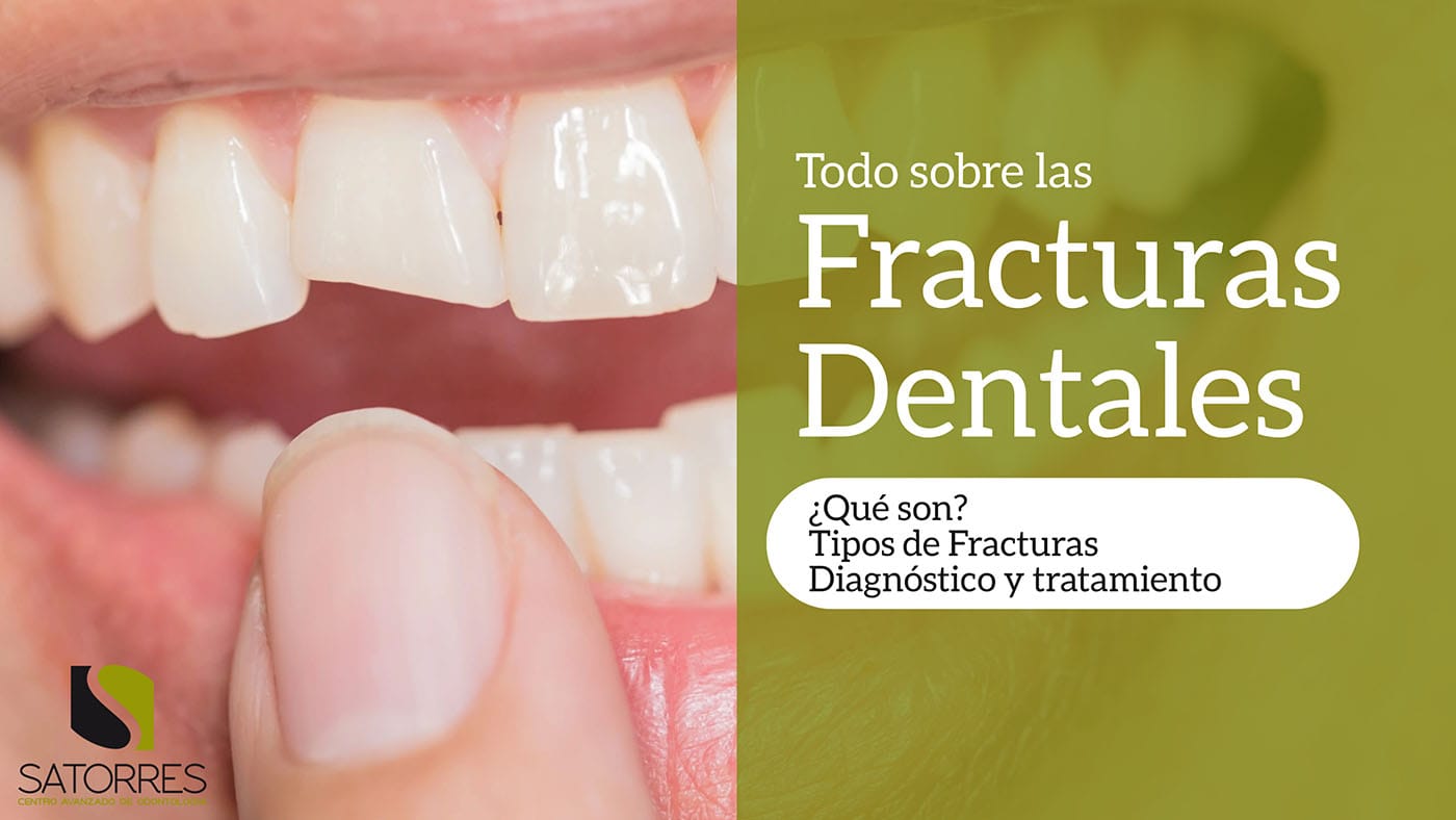 Fracturas Dentales. ¿Qué hacer? Diagnóstico y Tratamiento