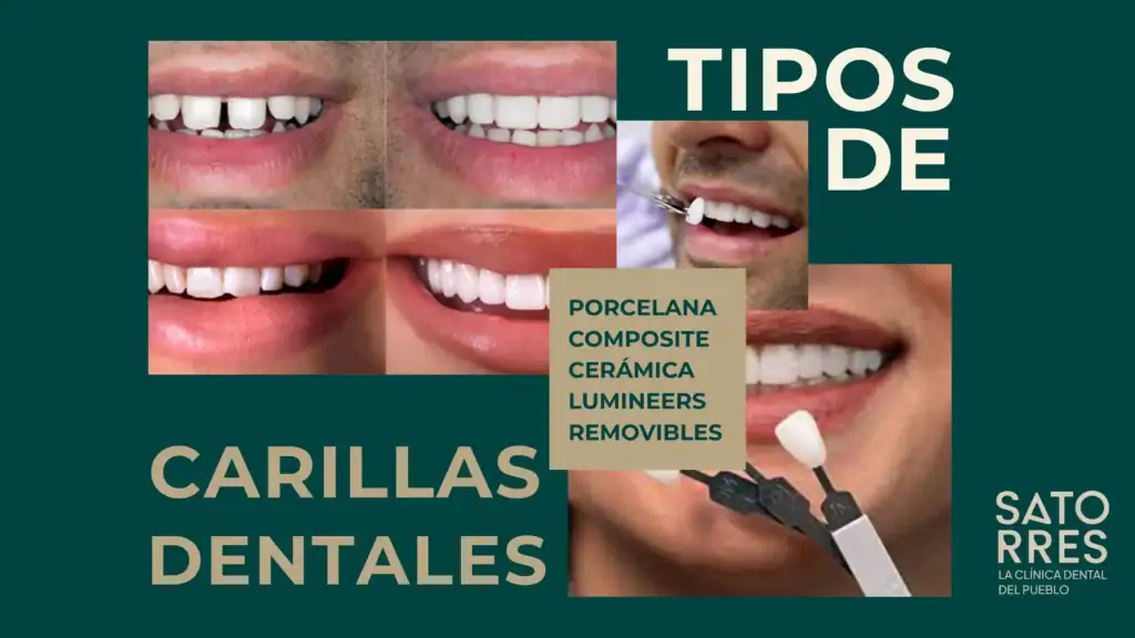 Tipos de Carilla: BANNER | Clínica Dental Satorres Paterna Manieses