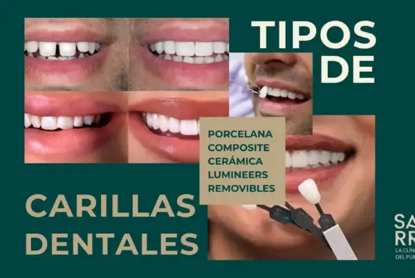 Tipos de Carilla: BANNER | Clínica Dental Satorres Paterna Manieses