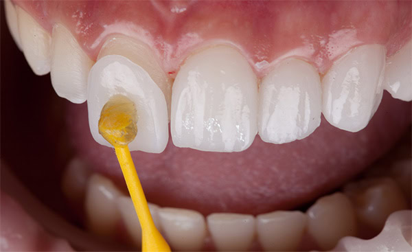 Tipos de Carilla: Cerámica | Clínica Dental Satorres Paterna Manieses