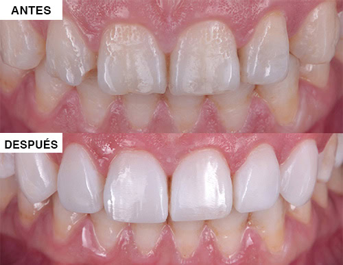 Tipos de Carilla: Composte | Clínica Dental Satorres Paterna Manieses