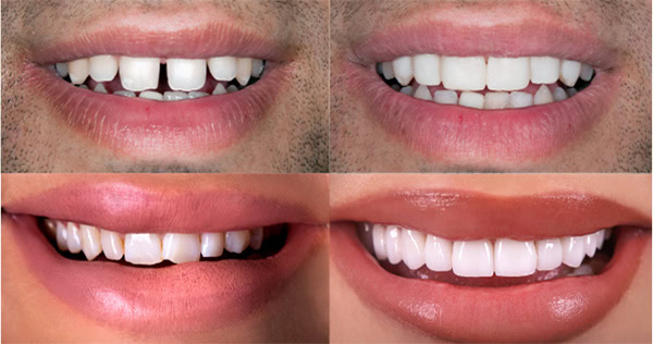 Tipos de Carilla: Porcelana | Clínica Dental Satorres Paterna Manieses