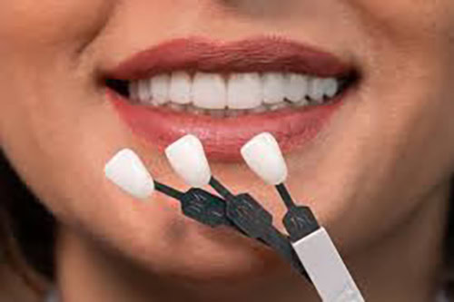 Tipos de Carilla: Lumineers | Clínica Dental Satorres Paterna Manieses