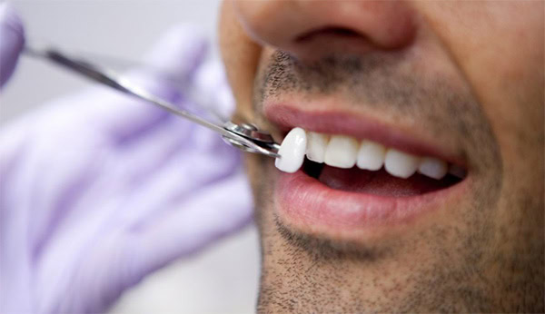 Tipos de Carilla: Colocación | Clínica Dental Satorres Paterna Manieses