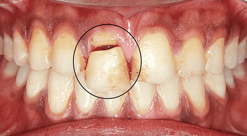 Fractura Dental Corona | Clínica Dental Satorres Paterna Manieses