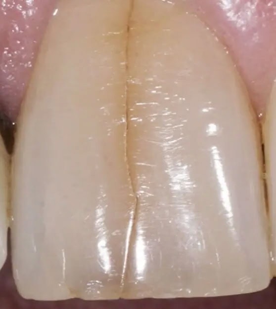 Fractura Dental Corona Radicular | Clínica Dental Satorres Paterna Manieses
