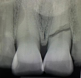 Fractura Dental Raiz | Clínica Dental Satorres Paterna Manieses