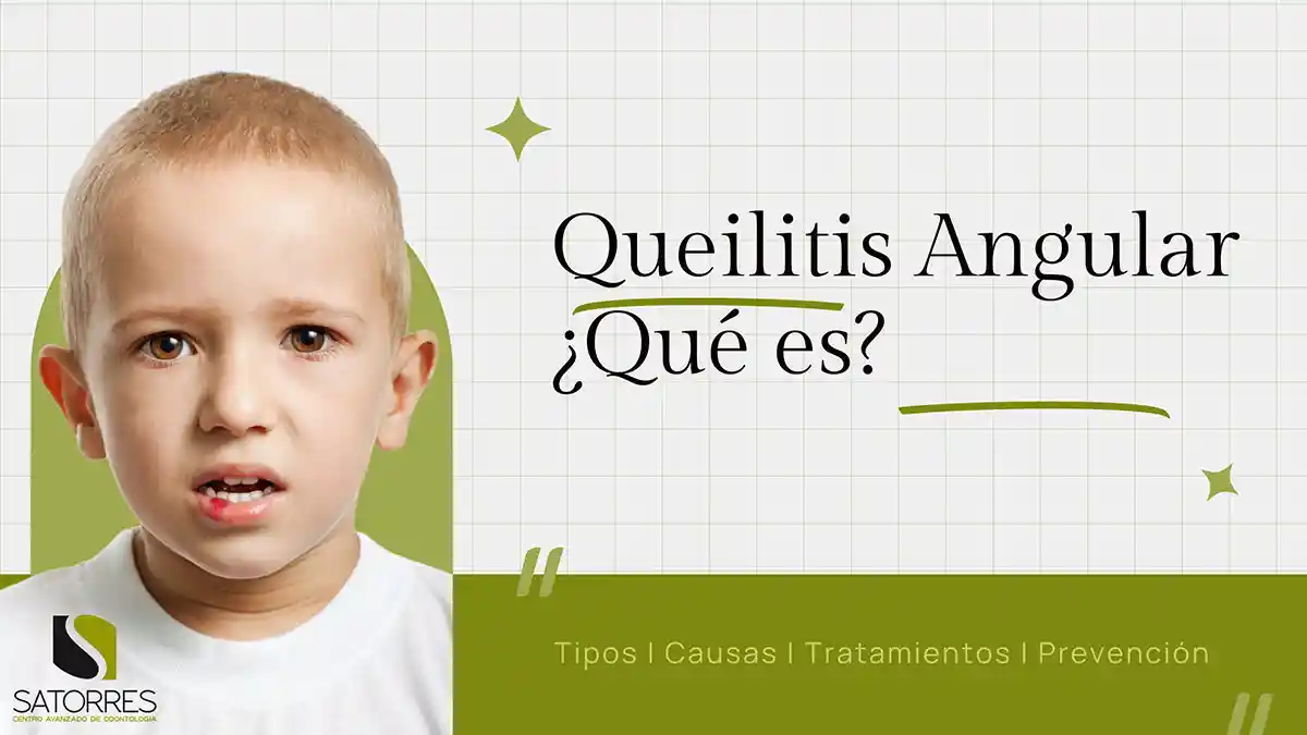 Queilitis angular: Qué es, causas y tratamiento de las boqueras