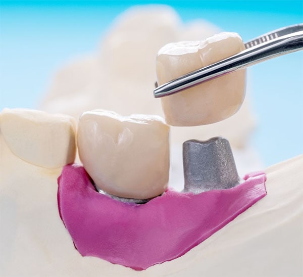 Implantes Dentales sin Tornillo | Clínica Dental Satorres - Paterna - Manises