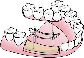 Implantes Dentales sin Tornillo | Clínica Dental Satorres - Paterna - Manises